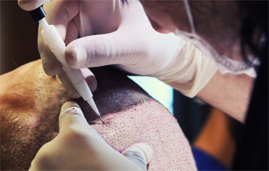 DHI haartransplantation - Verpflanzung