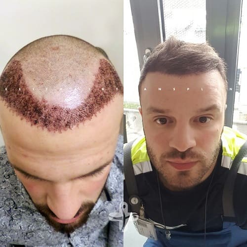 Haartransplantation Türkei Vorher Nachher Haartransplantation Türkei Vorher Nachher