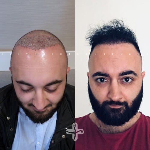 Haartransplantation Türkei Vorher Nachher Haartransplantation Türkei Vorher Nachher