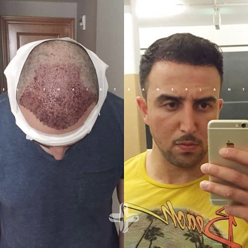 Haartransplantation Türkei Vorher Nachher Haartransplantation Türkei Vorher Nachher