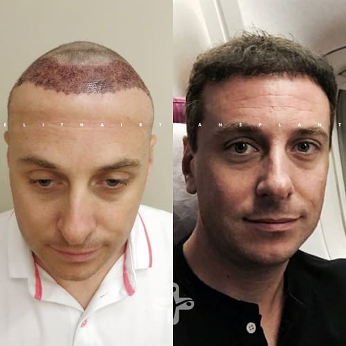 Haartransplantation Türkei Vorher Nachher Haartransplantation Türkei Vorher Nachher