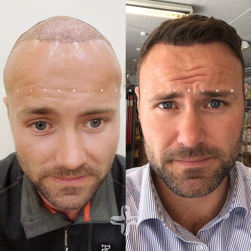 Haartransplantation Türkei Vorher Nachher Haartransplantation Türkei Vorher Nachher