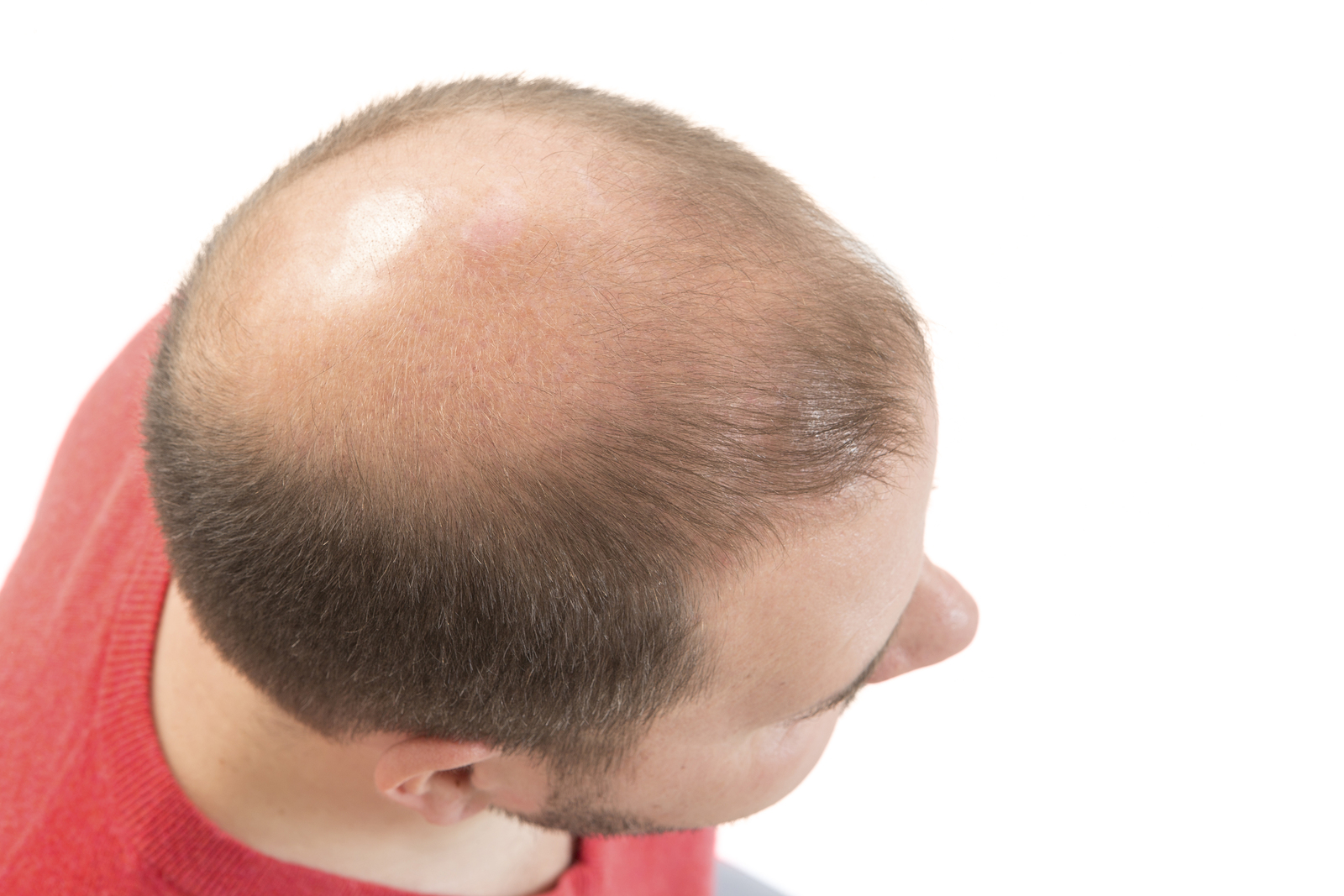 Seborrhoische Dermatitis mit Haarausfall