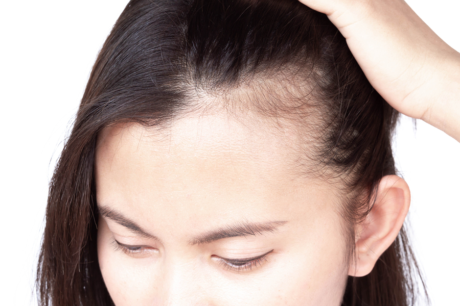 Anhaltender Haarausfall - Ursachenforschung und Behandlungsmöglichkeiten