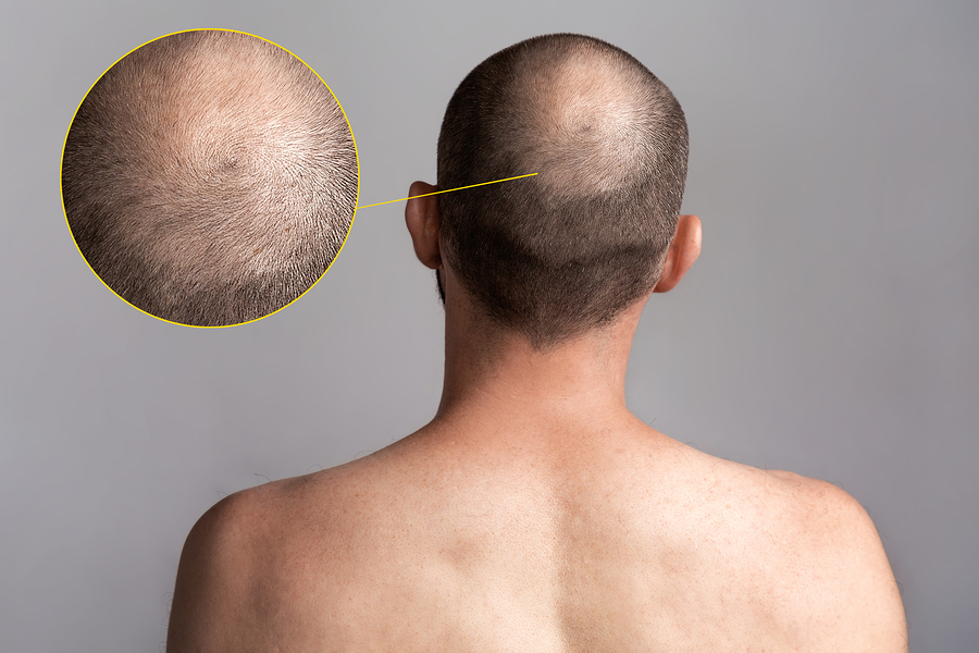 Shock Loss Haarausfall bei Haartransplantationen