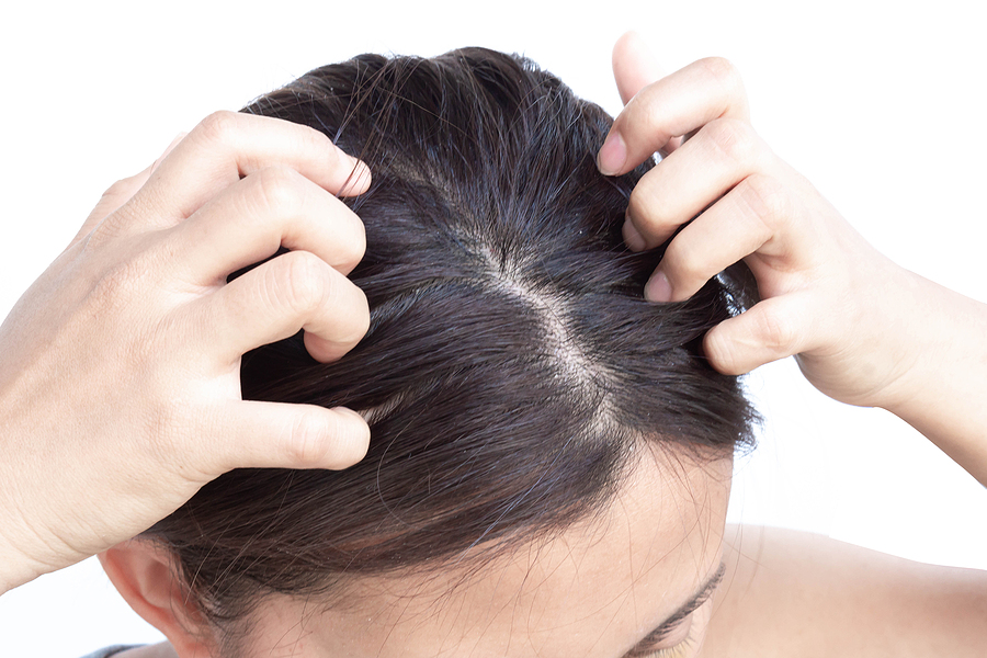 Haarausfall durch trockene Kopfhaut - wie ist das möglich