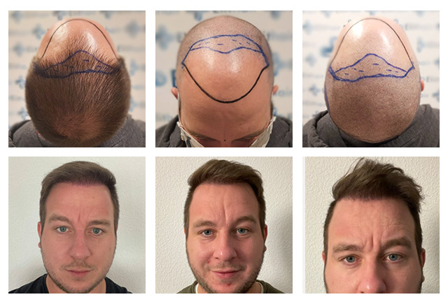 DHI Haartransplantation Vorher Nachher männlicher Patient