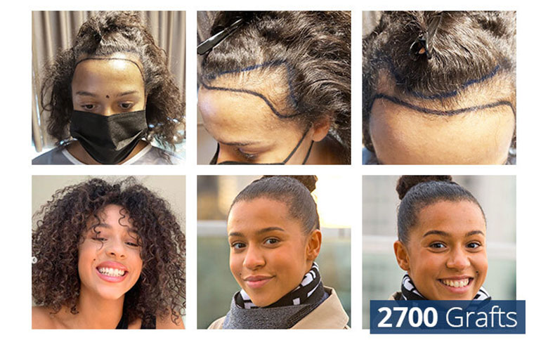 Patientin im Vorher Nachher Vergleich bei der Haartransplantation für Frauen