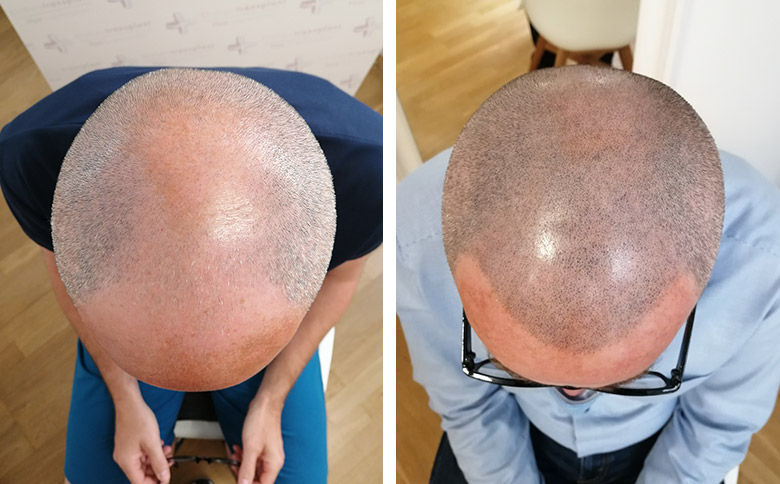 Mann Patient Haarpigmentierung Vorher Nachher