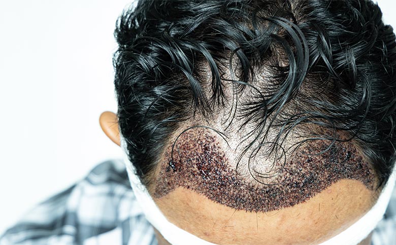Patient zeigt seinen Oberkopf nach der Haartransplantation ohne Rasur