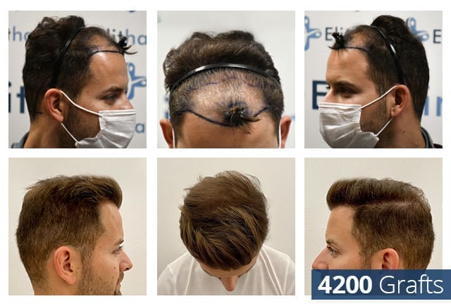 Haartransplantation Patient im Vorher Nachher Resultat