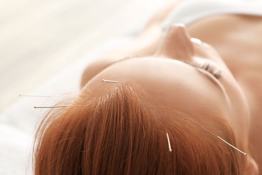 Akupunktur bei Haarausfall